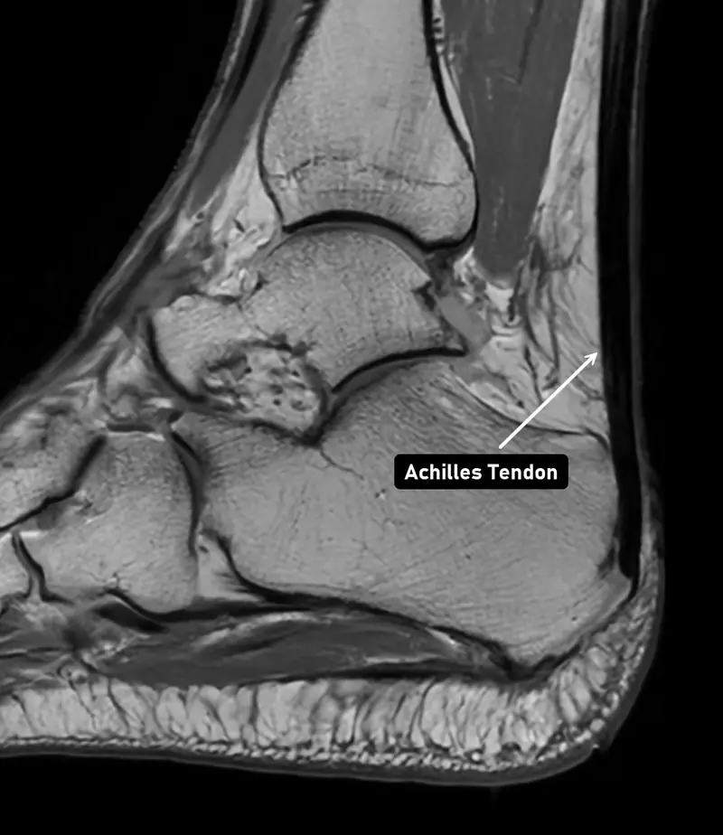 Sagittal MRI of the ankle with the Achilles tendon labeled, showing the thick tendon running down the back of the heel to the calcaneus.