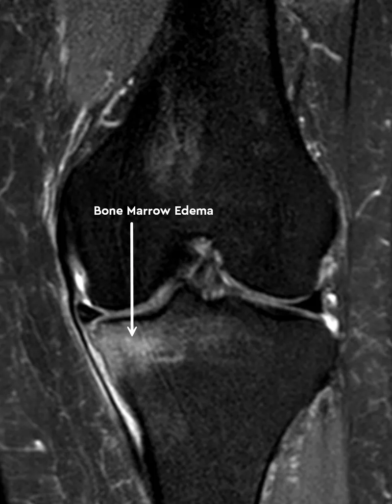Coronal MRI of a knee showing bone marrow edema in the tibia beneath the worn medial cartilage