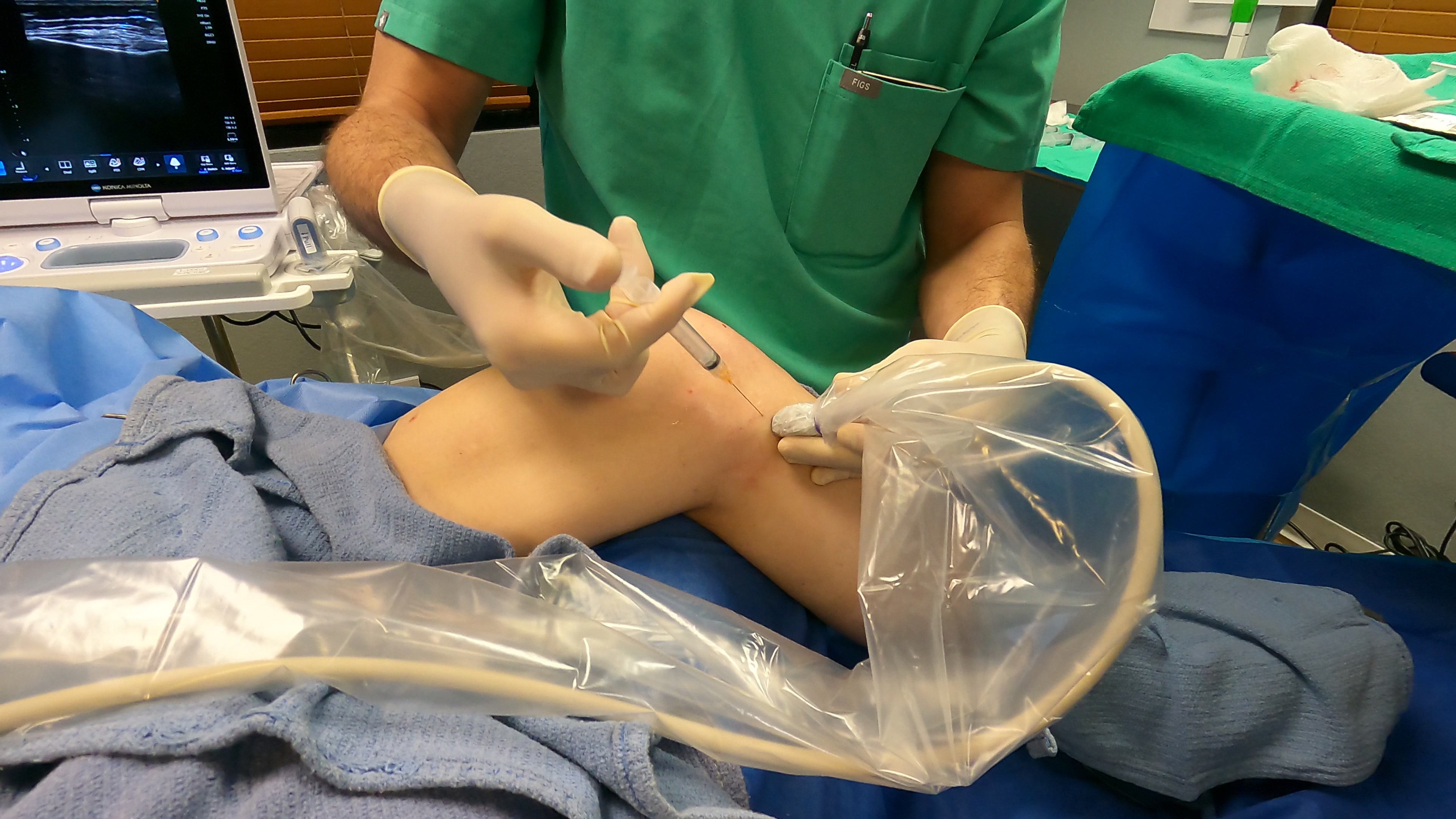 Ultrasound-guided PRP injection at Regenerative Performance