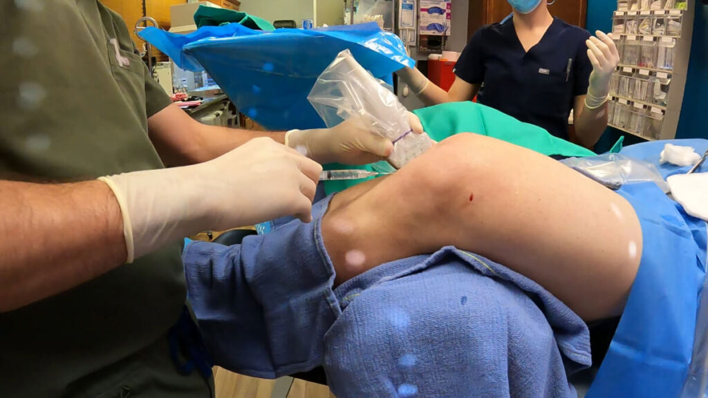 Prolotherapy Knee