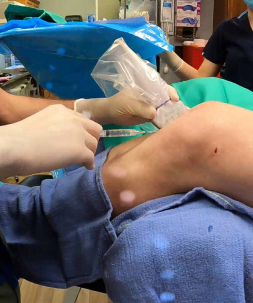 Prolotherapy Knee